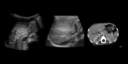 Focal Nodular Hyperplasia Liver