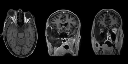 Mucormycosis